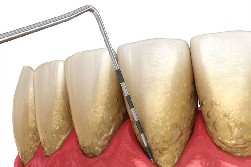 Close-up illustration of periodontal probe measuring pocket depth and visible tartar on teeth