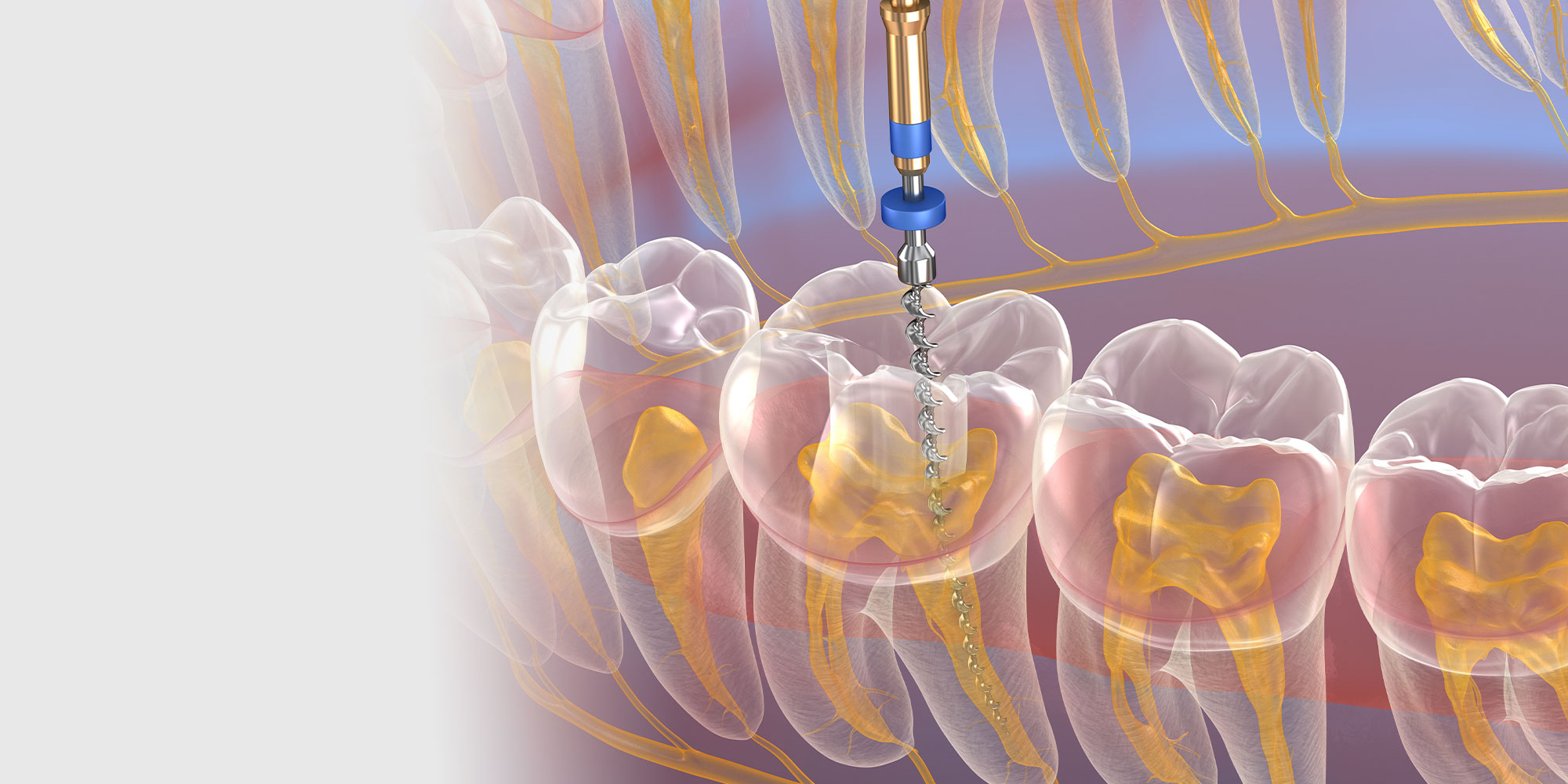 3D illustration of root canal procedure showing internal tooth structure and dental drill