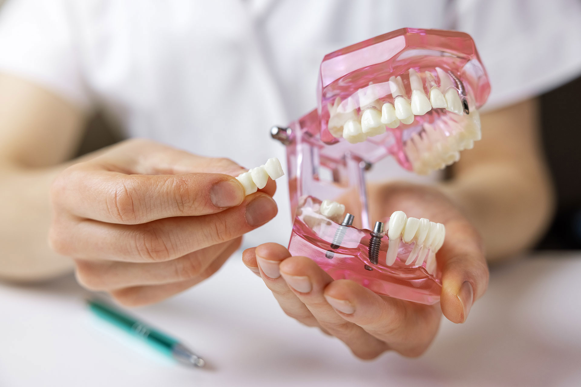 Close-up of dentist holding dental implant model to explain tooth replacement procedure