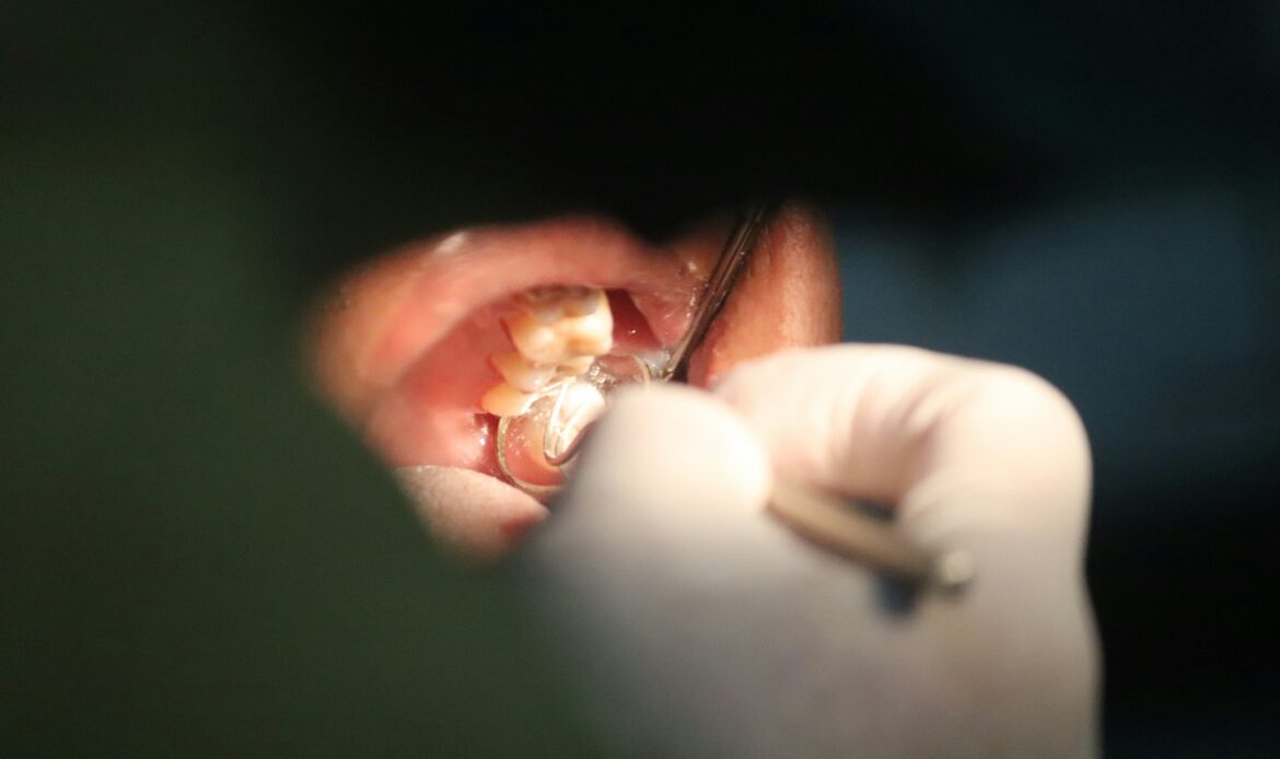 Close-up of frenectomy procedure at Dr. Friedberg & Associates in Houston