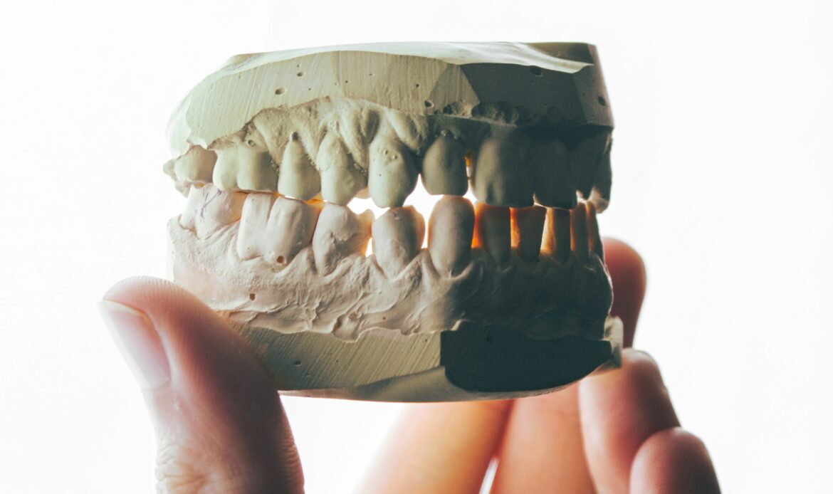 Dental implant model with crown on plaster jaw – dental implants Houston