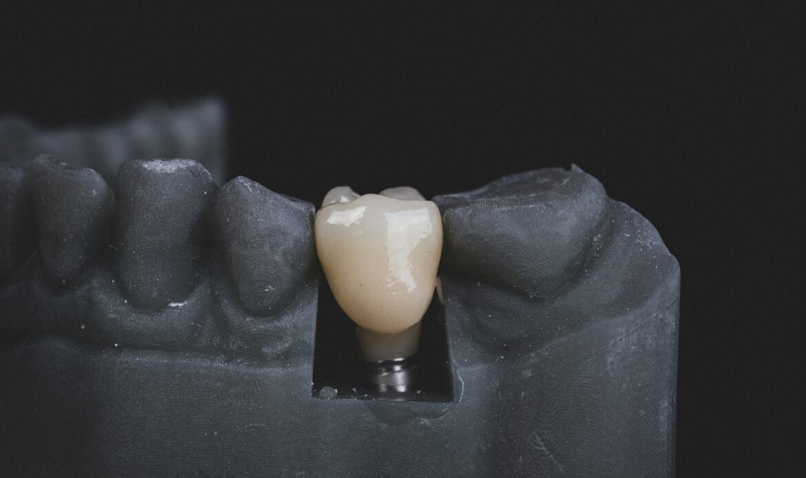 Dental implant crown on model jaw – dental implants Houston
