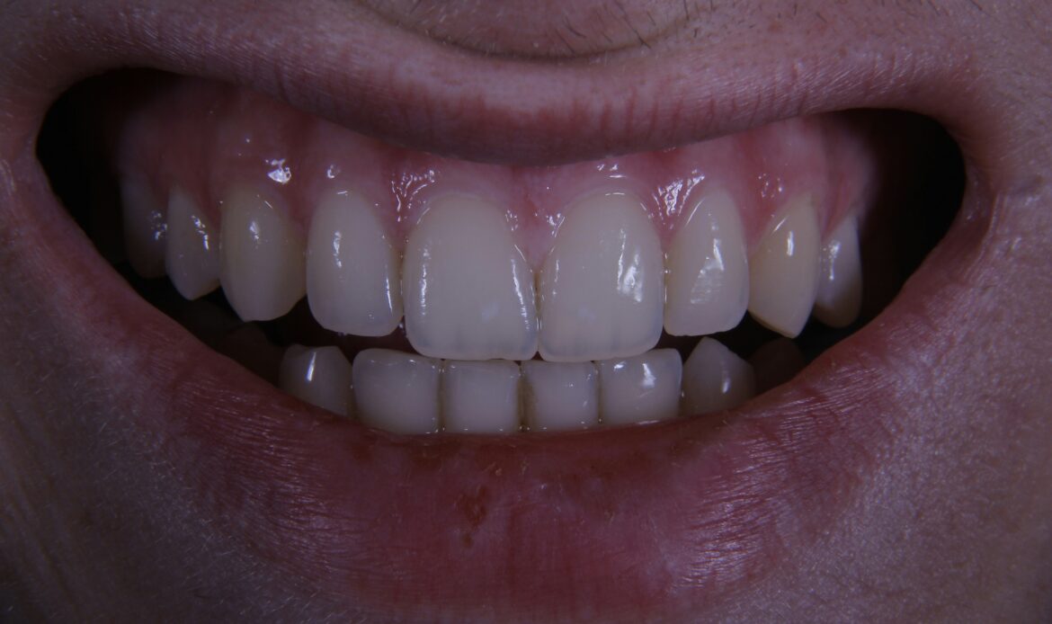 Healthy smile after implant repair at Dr. Friedberg & Associates