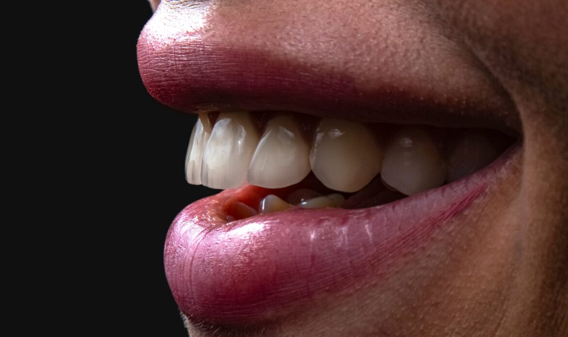 Close-up of a smile before dental implants – candidate for pterygoid implants