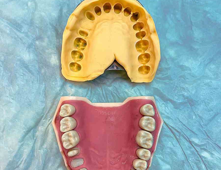 Dental implants Houston TX impression tray and upper arch try-in model
