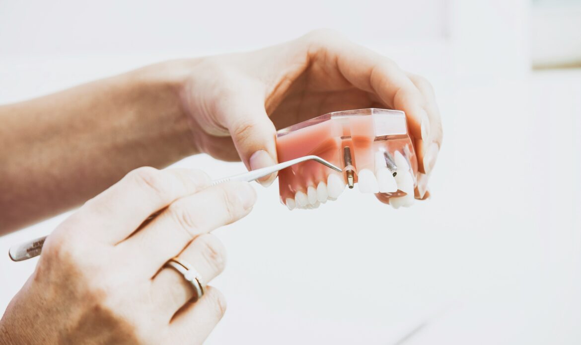 Dental implants Houston TX model showing titanium implant placement