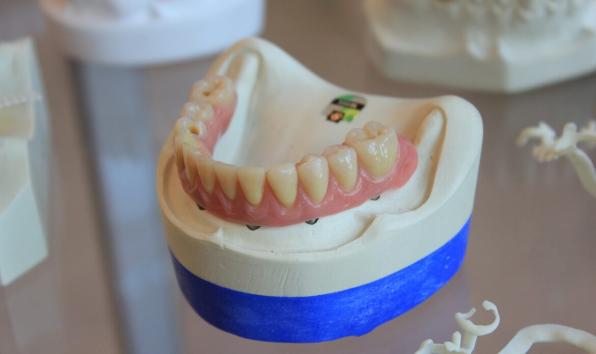 teeth implants near me in Houston dental model showing implant placement