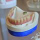 teeth implants near me in Houston dental model showing implant placement