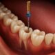 root canal with IV sedation in Houston dental procedure illustration