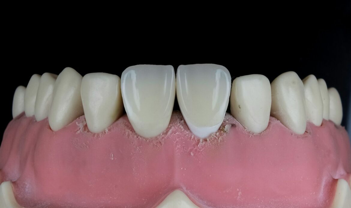 close-up illustration of gum recession showing exposed tooth roots