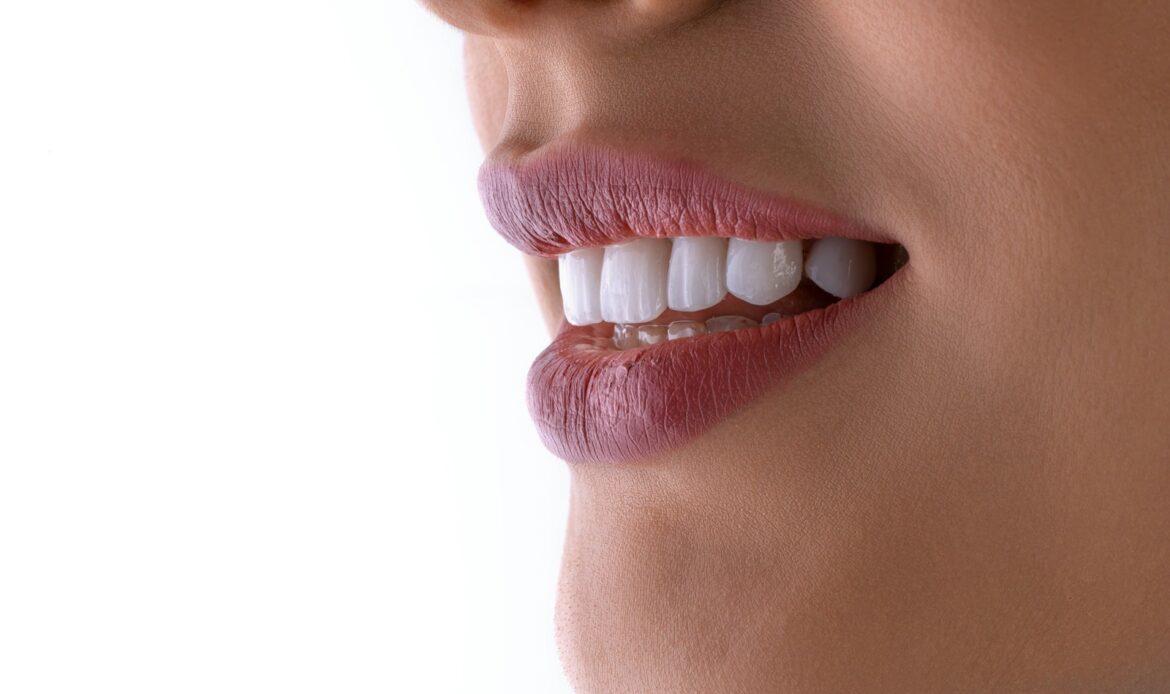 Smiling woman showing healthy white teeth, used to illustrate how long do dental implants last