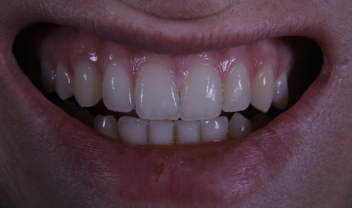 close-up photo of a patient smiling with a missing front tooth before dental implant treatment