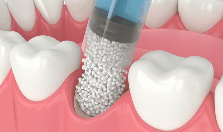 Bone graft Houston illustration showing graft material placed into tooth socket