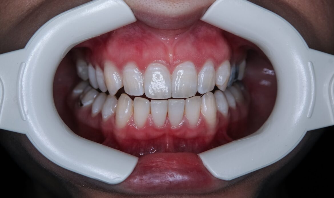 patient undergoing professional teeth whitening treatment with cheek retractor