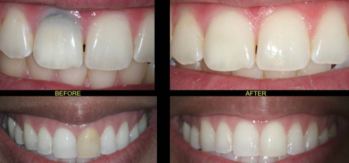 internal tooth bleaching before and after results on a root canal treated tooth