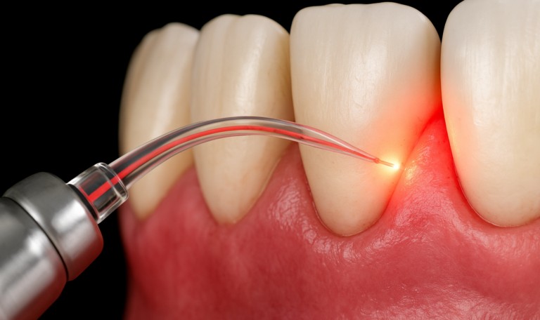 LANAP laser treating inflamed gums during periodontal procedure