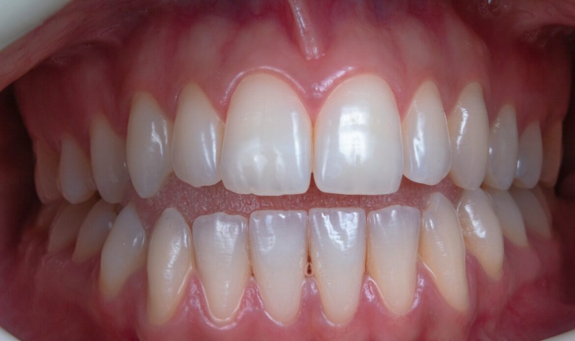 internal tooth bleaching results on a root canal treated tooth