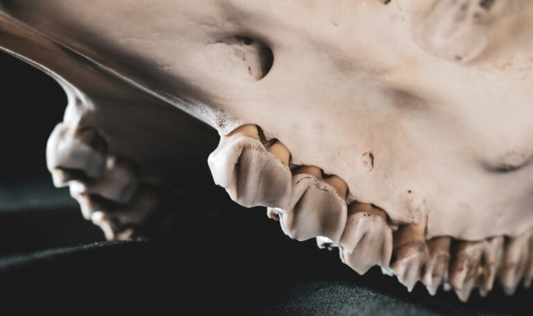 Osseous surgery illustration showing gum disease, tartar buildup, and exposed bone