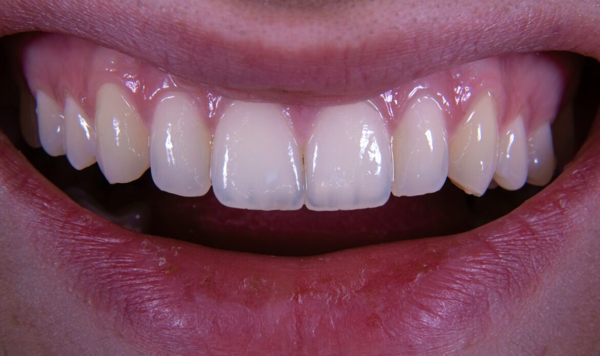 gummy smile showing excess gum display before treatment