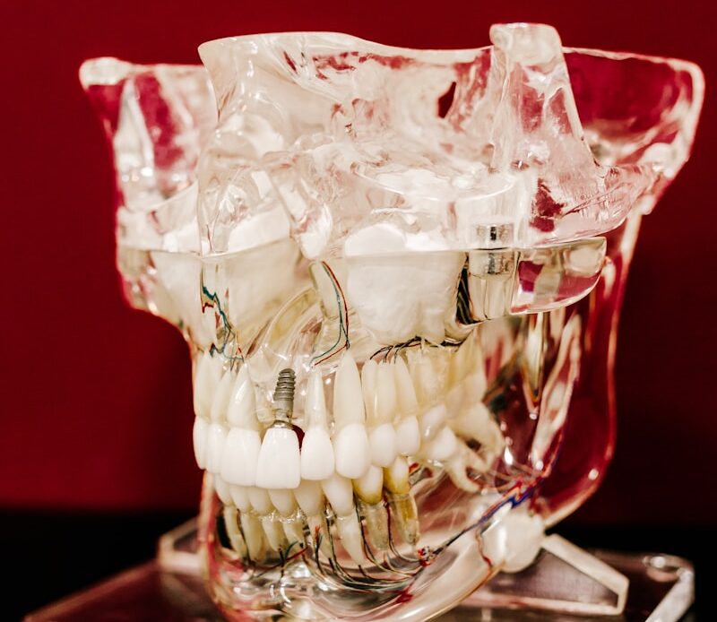 Best dental implants in Houston showing dental implant structure and restored teeth