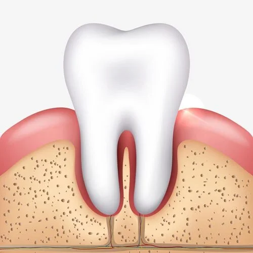 Illustration showing bone loss around a loose tooth in adults due to periodontal support breakdown