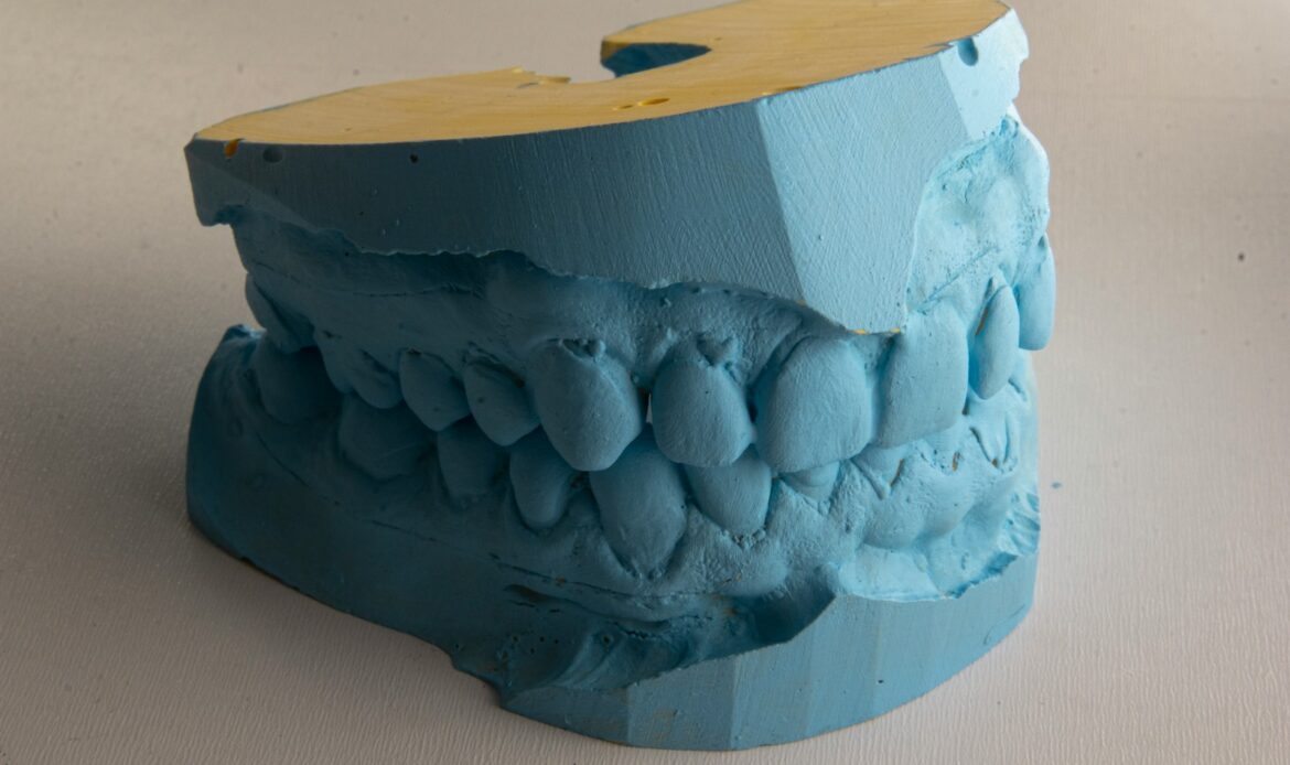 full mouth implants dental model impression