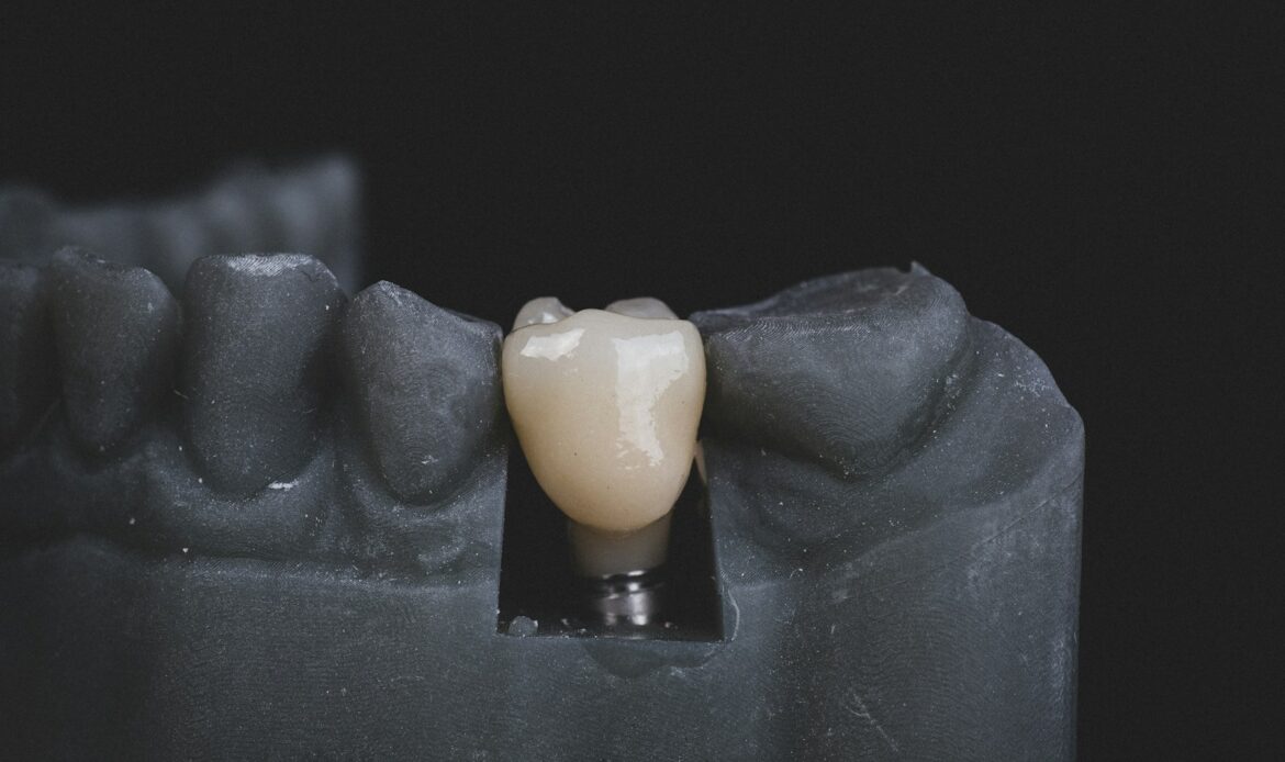 permanent teeth implants replacing a single missing tooth