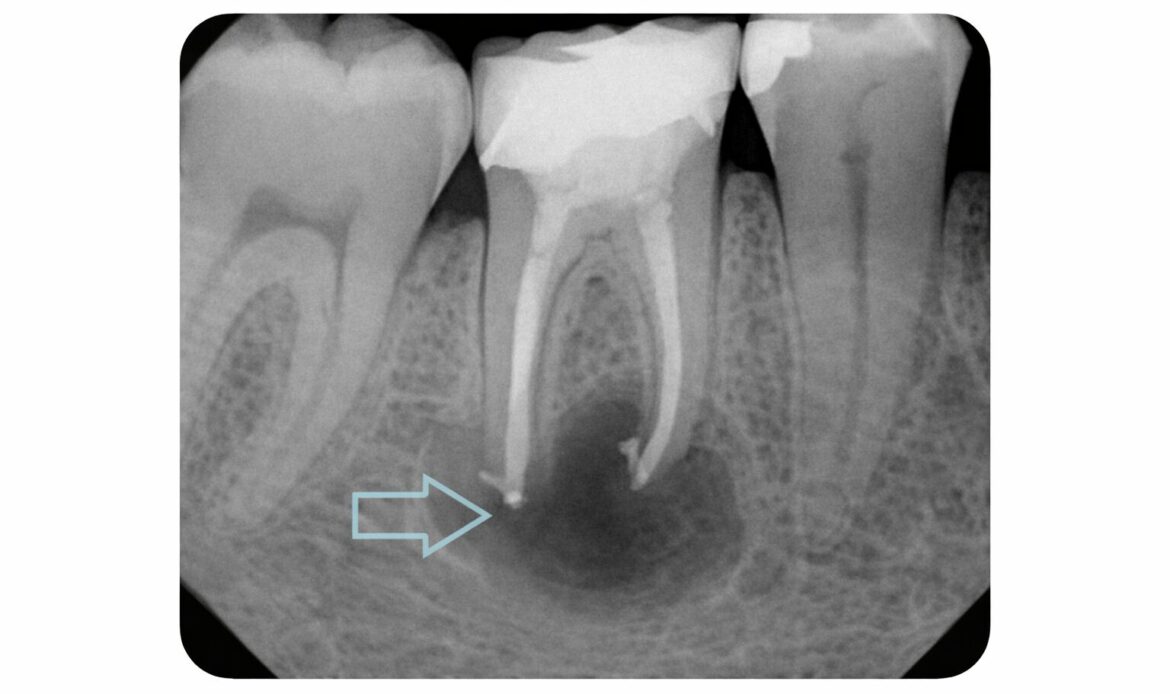 tooth vs gum infection x ray
