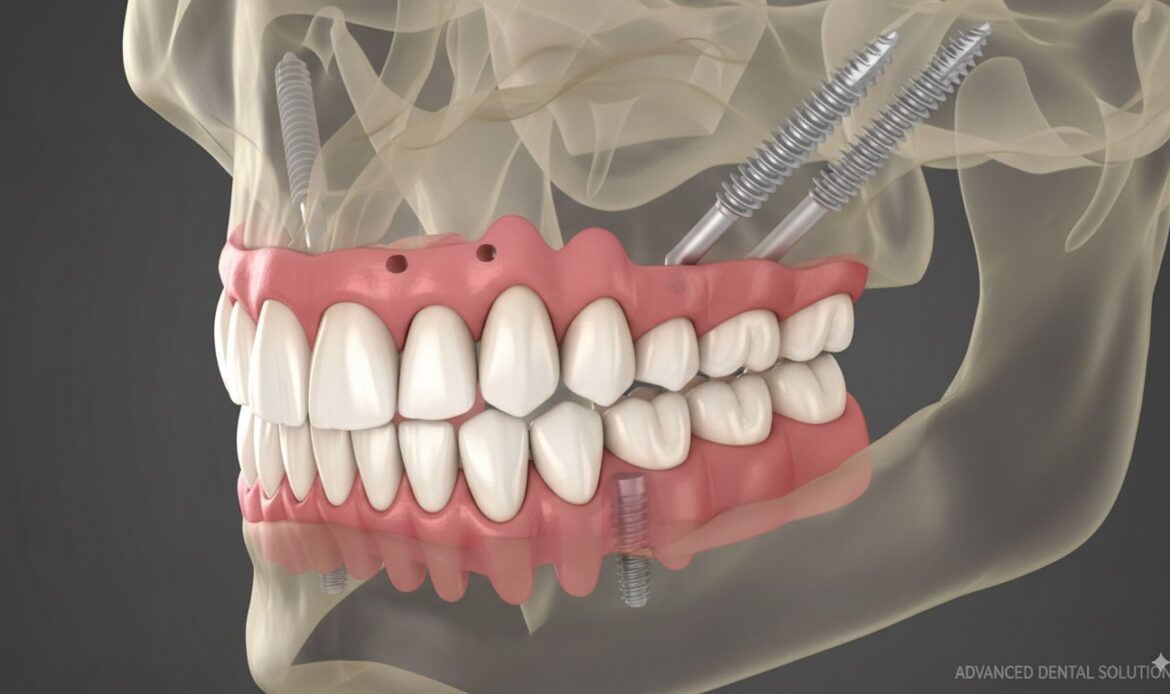 dental implant structure diagram implant cost Houston explanation