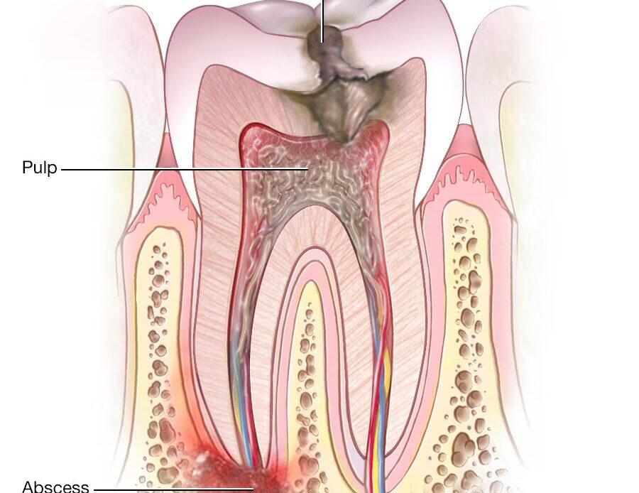 tooth infection causing periapical abscess at root