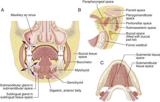 tooth infection spreading to jaw neck and facial spaces