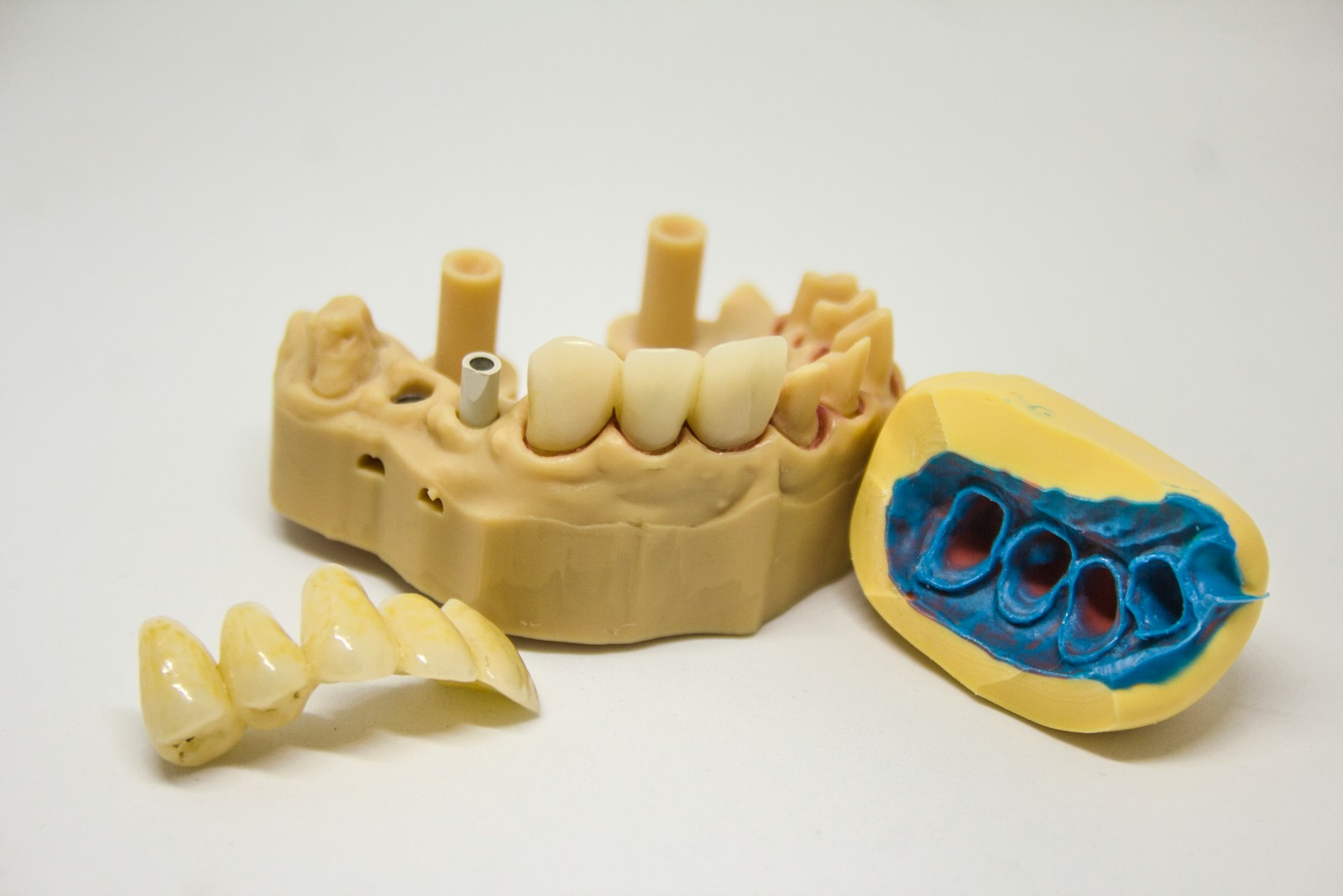 Dental model showing treatment planning for delaying dental implants and bone loss