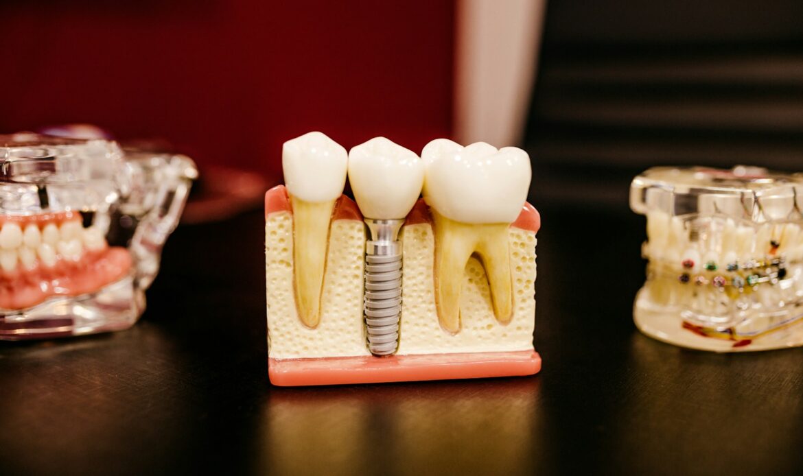 missing tooth replacement dental implant model