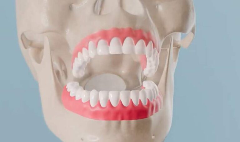 Dental model illustrating how dental implants replace missing teeth
