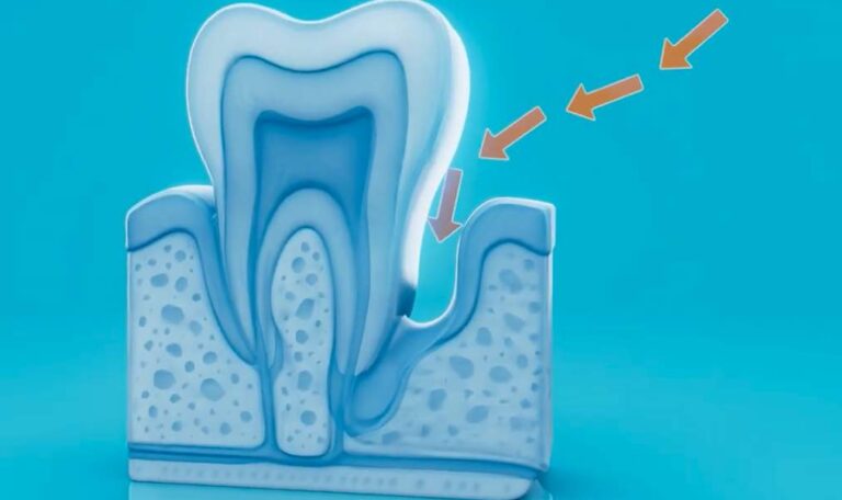 Illustration showing gum recession around a tooth and exposed tooth root