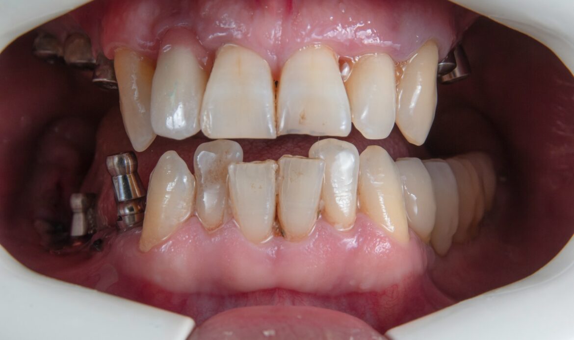 Failed Dental Implant Houston patient with severe tooth and gum deterioration