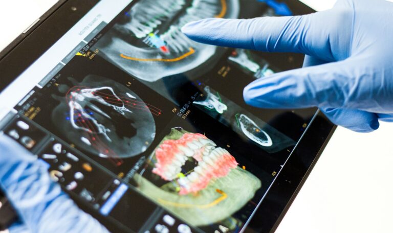 Zygomatic Implants Houston treatment planning using CBCT imaging