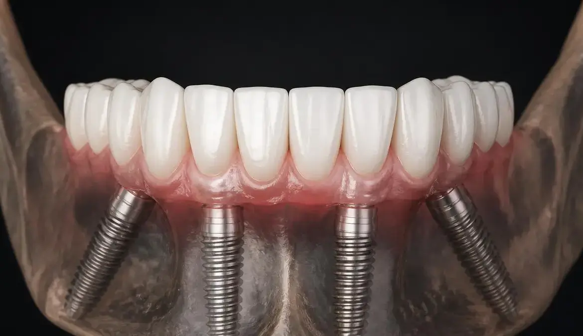 3D render of four titanium dental implants placed in the lower jaw for All-on-4 treatment