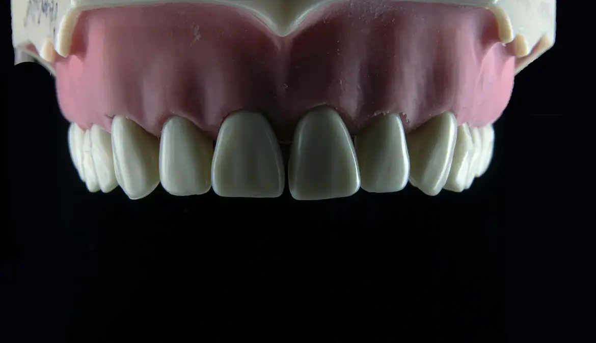 Close-up of a fixed dental implant bridge model compared to removable dentures