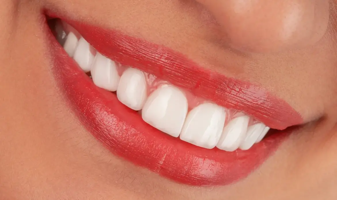 Crown lengthening result showing balanced gumline on upper front teeth