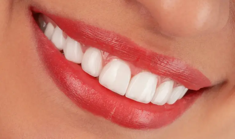 Crown lengthening result showing balanced gumline on upper front teeth