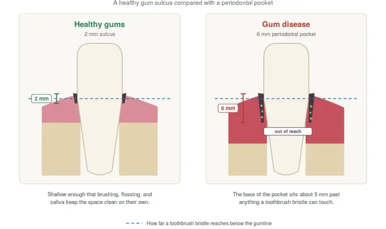 Diagram comparing a healthy 2 mm gum sulcus to a 6 mm periodontal pocket, showing how far a toothbrush bristle reaches