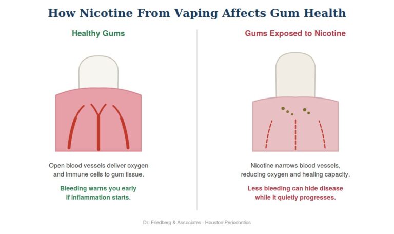 Vaping and gum disease diagram showing how nicotine narrows gum blood vessels and hides bleeding