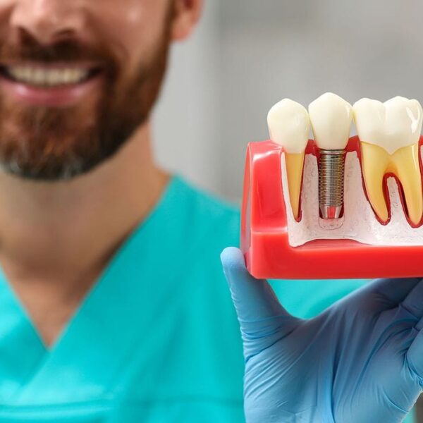 Dental implant model held by Houston periodontist at Dr. Friedberg & Associates